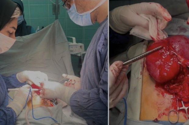 خارج کردن تومور شکمی از بدن کودک ۱۰ساله در مرکز آموزشی و درمانی ۱۷ شهریور رشت